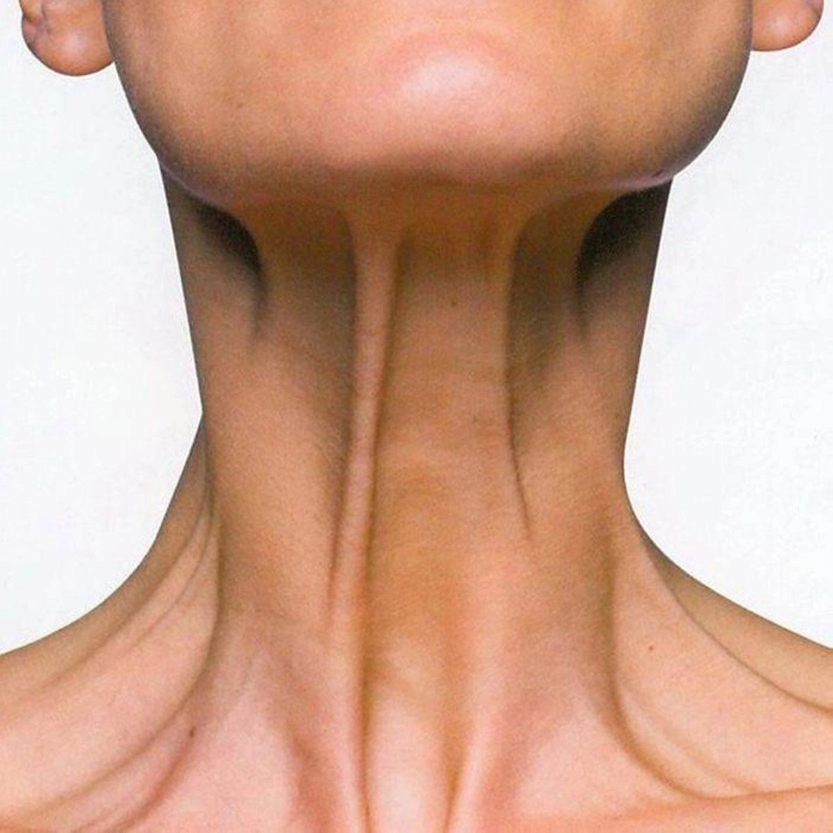 حقن البوتوكس للرقبة: شباب بلا جراحة