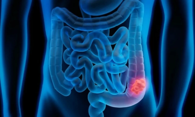 وفاة جيمس فان دير بيك: سرطان القولون يهدد الشباب وأعراض خفية